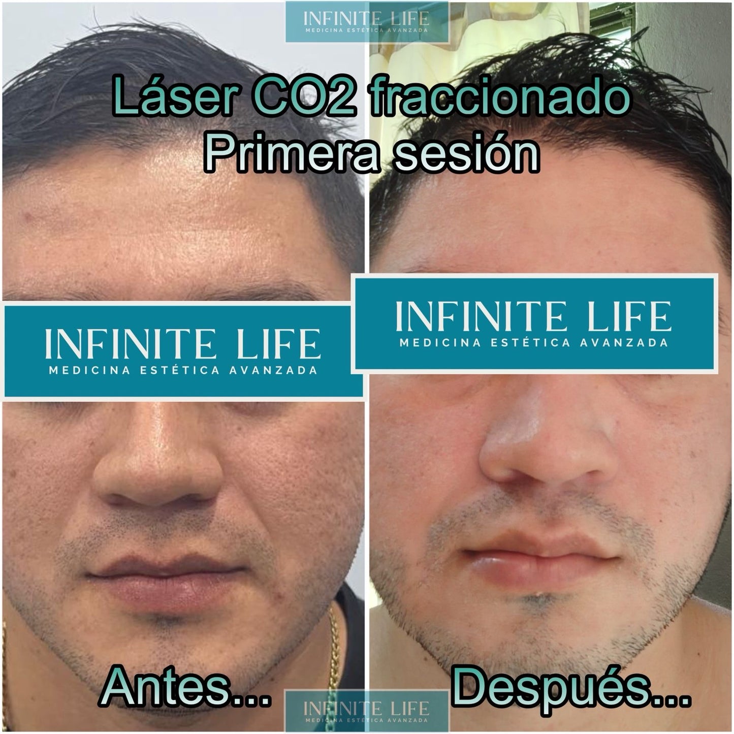 Rejuvenecimiento Facial con Láser con CO2