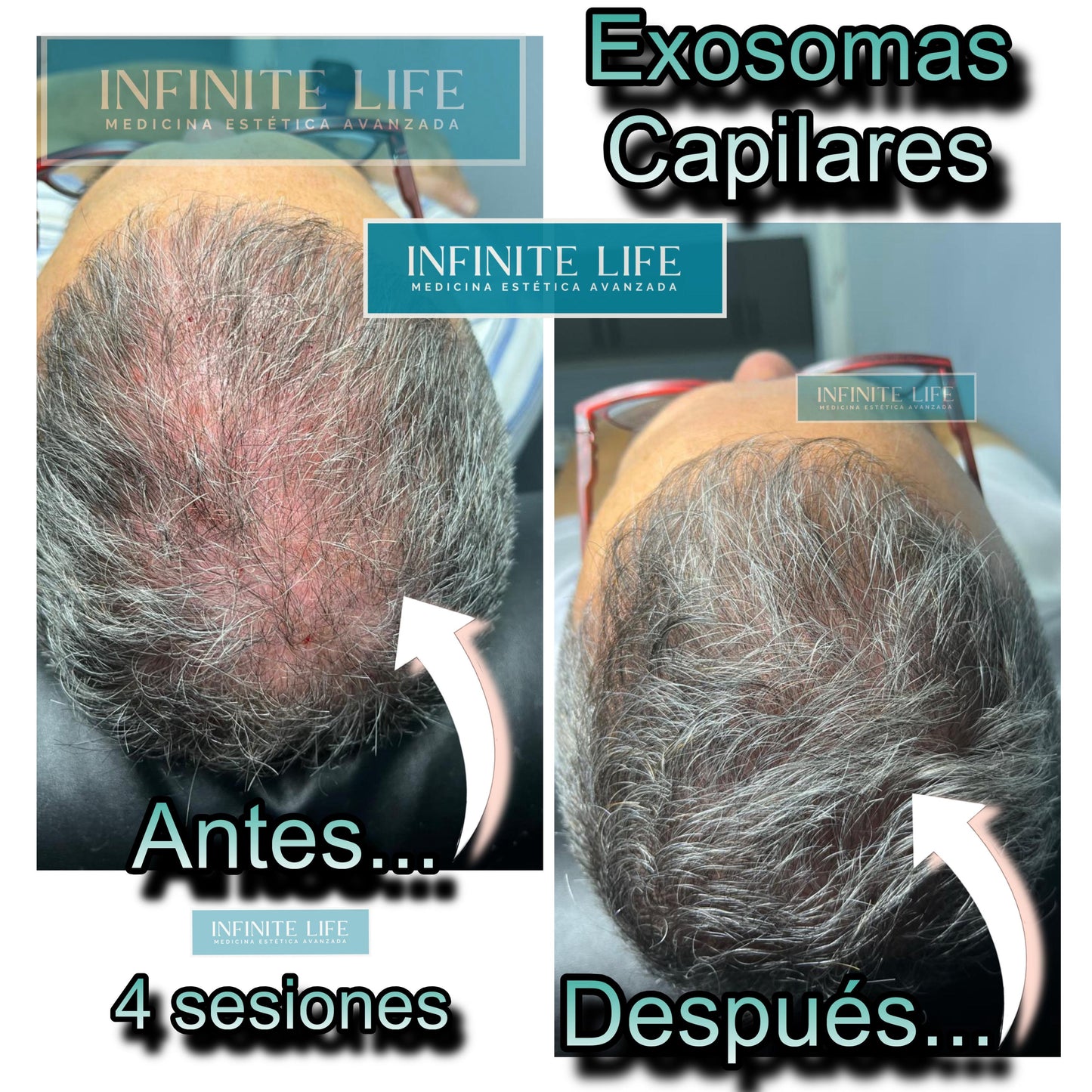 EXOSOMAS Capilares
